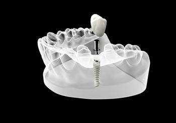 Understanding the Single Tooth Implant Cost in Australia single-tooth-implant-cost-australia-illustration-preston