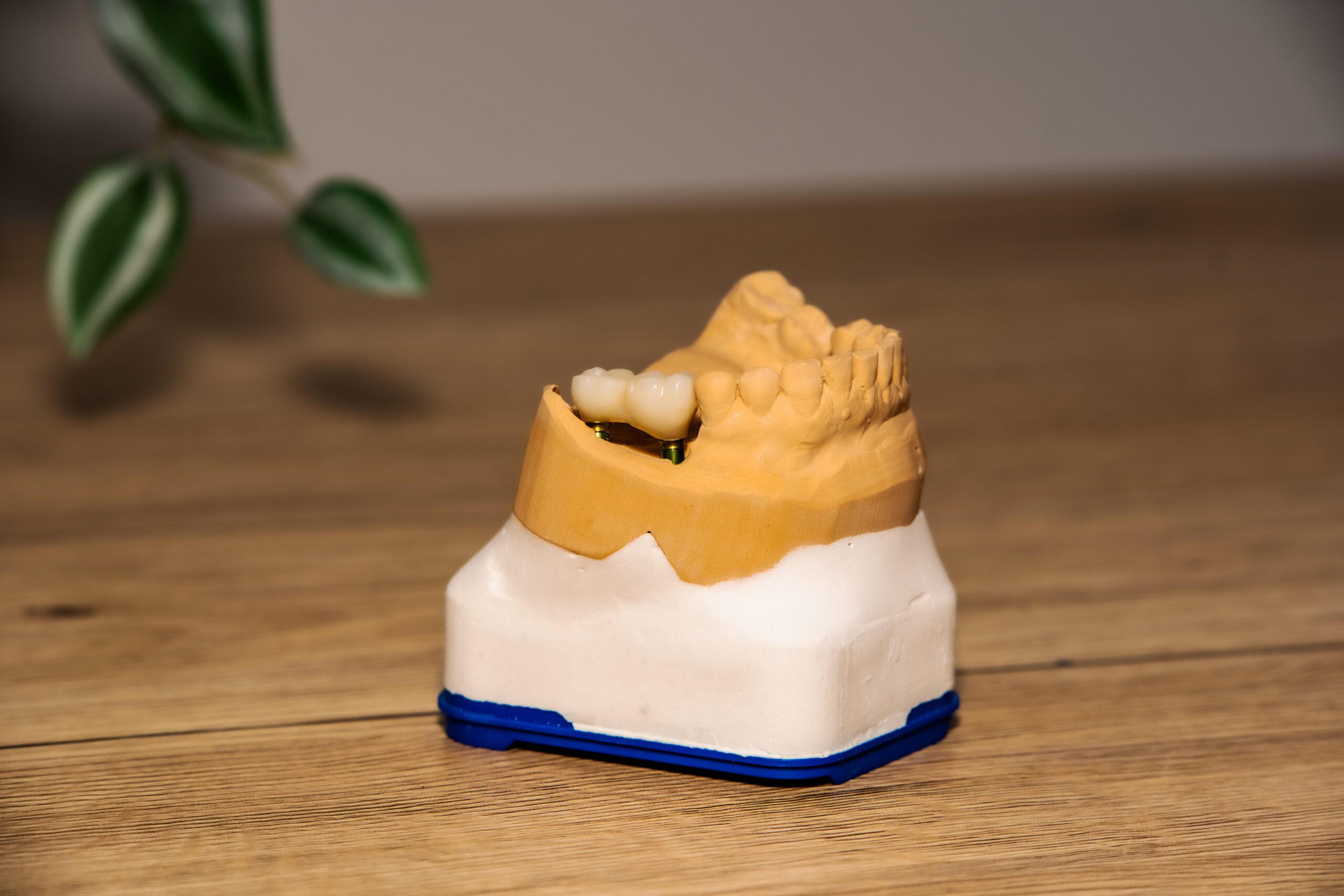 Dental Implants dental bridge - preston