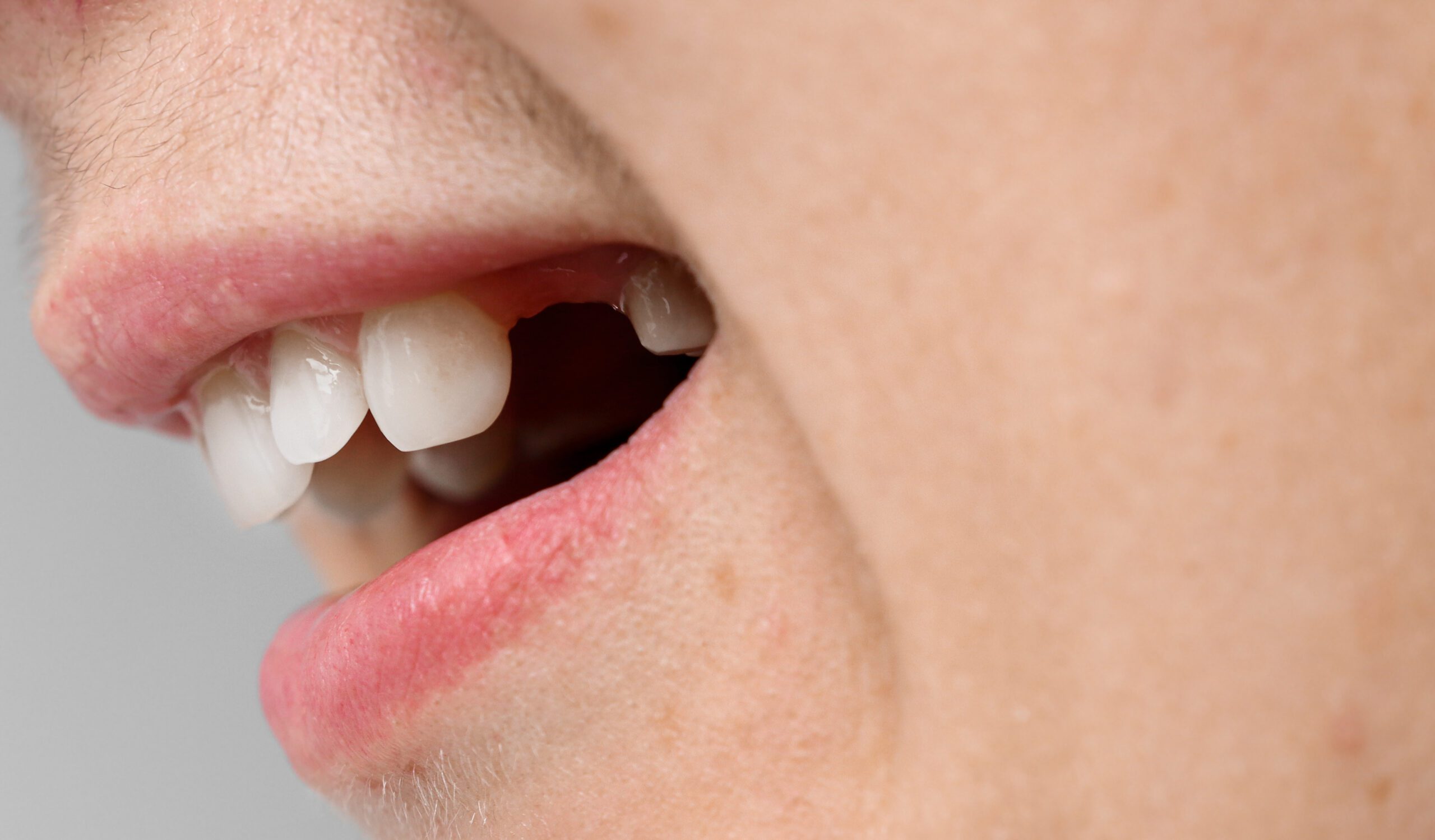 Dental Bridges dental bridges - preston