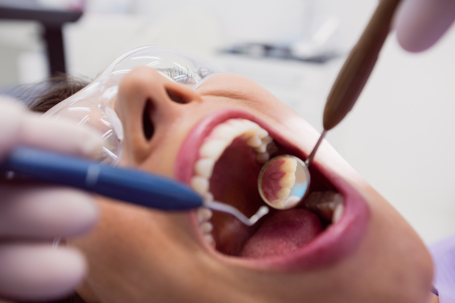 Dental Fillings dental fillings - preston