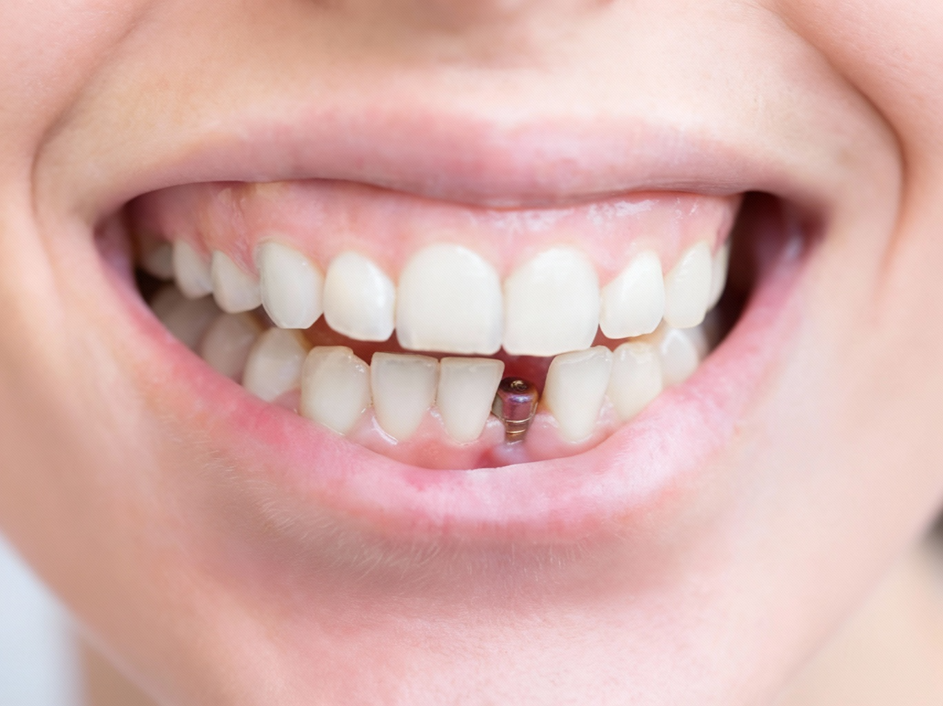 Single Dental Implants single dental implants - preston