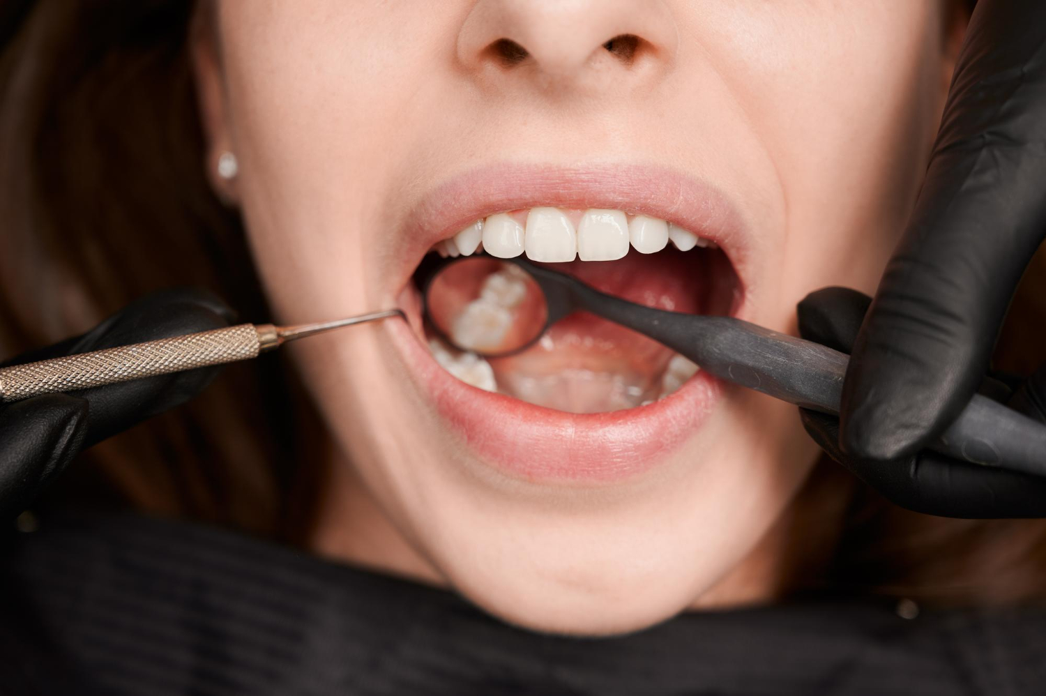 Other Dentistry wisdom teeth removal - preston